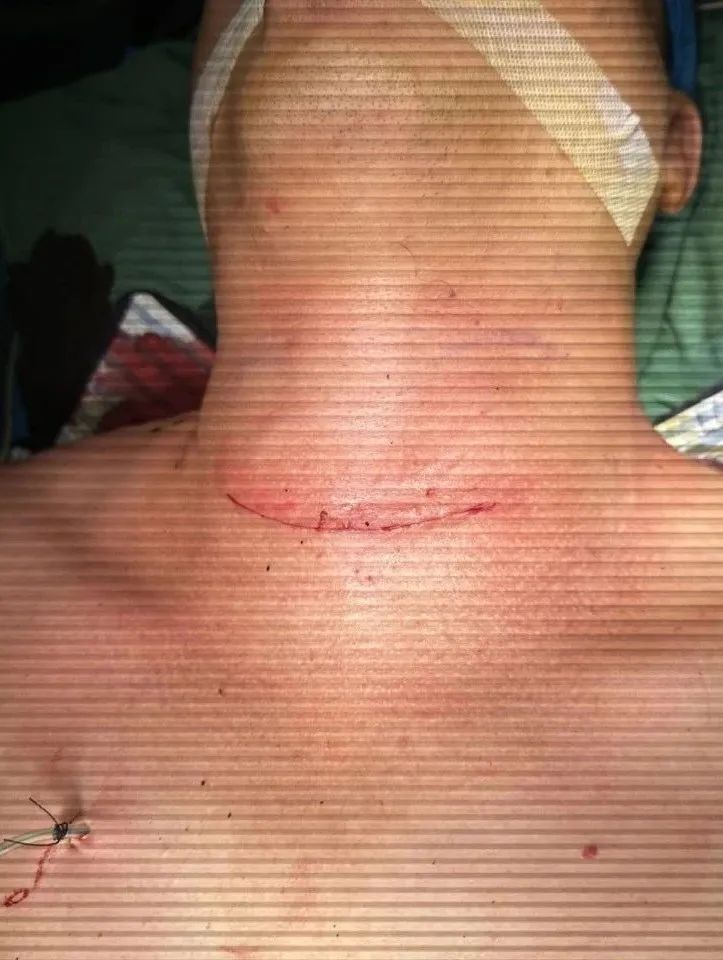 【福德甲乳】甲亢、巨大甲状腺肿成功手术