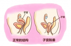 【福德妇科】不开刀！无切口！解决子宫脱垂！