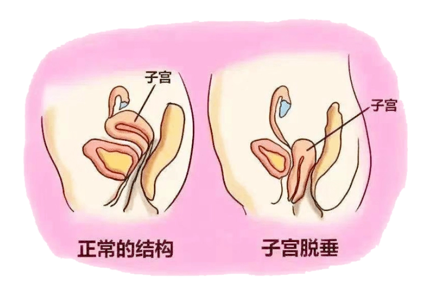 【福德妇科】不开刀！无切口！解决子宫脱垂