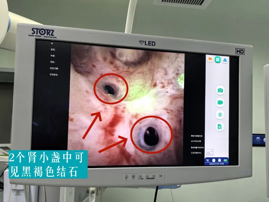 【福德泌尿】结石治疗新选择！一根“软镜”无创碎石！
