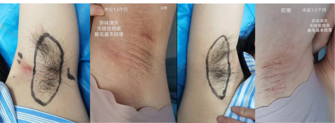 莆田福德医院-微创腋臭祛除，告别异味尴尬 