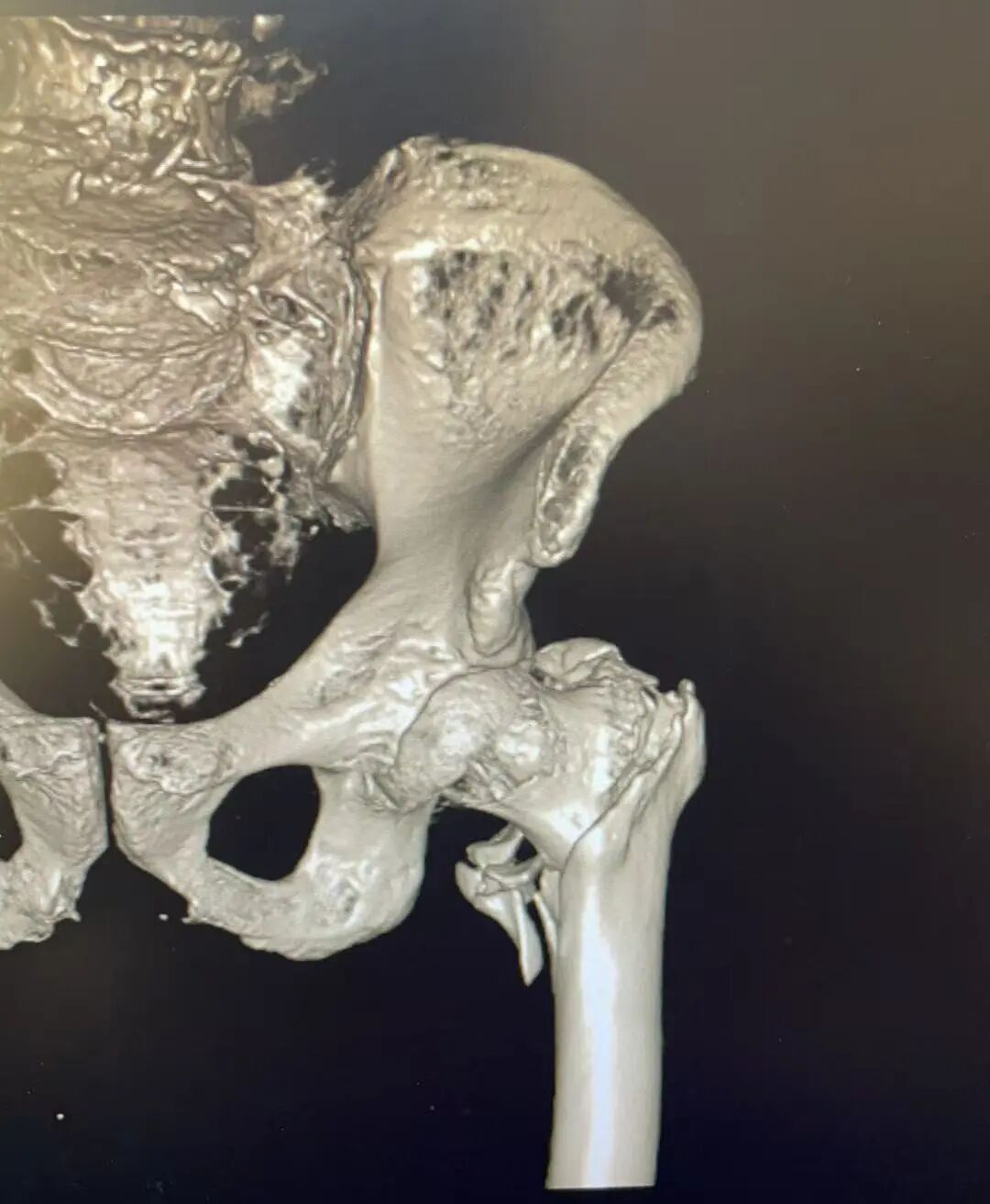 【福德骨科】微创手术攻克“人生最后一次骨折”，让高龄不再是禁区！