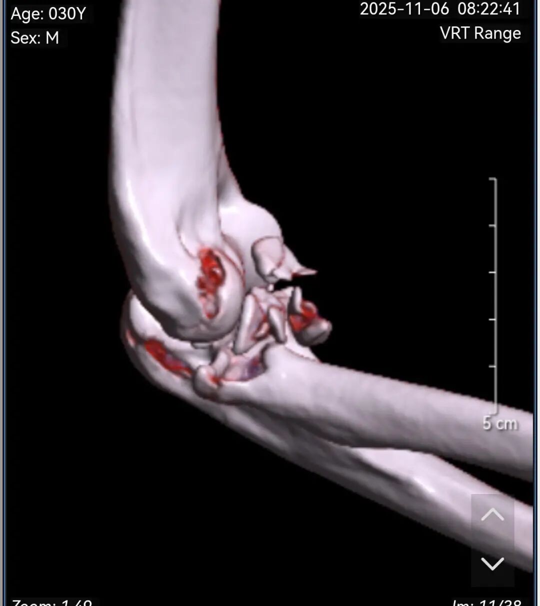 【骨科联盟】莆田福德医院黄益平主任成功实施肘关节“恐怖三联征”手术