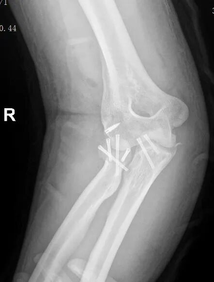 【骨科联盟】莆田福德医院黄益平主任成功实施肘关节“恐怖三联征”手术