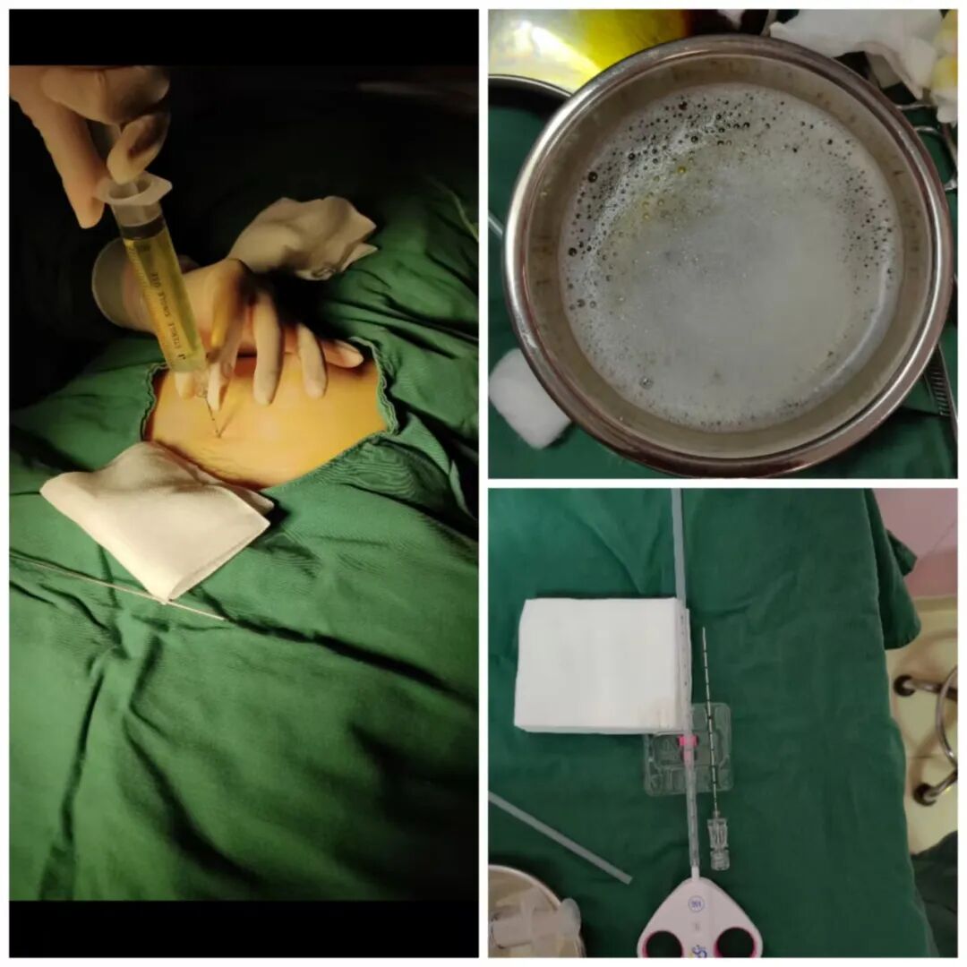 【福德妇科】微创穿刺化解卵巢囊肿困扰