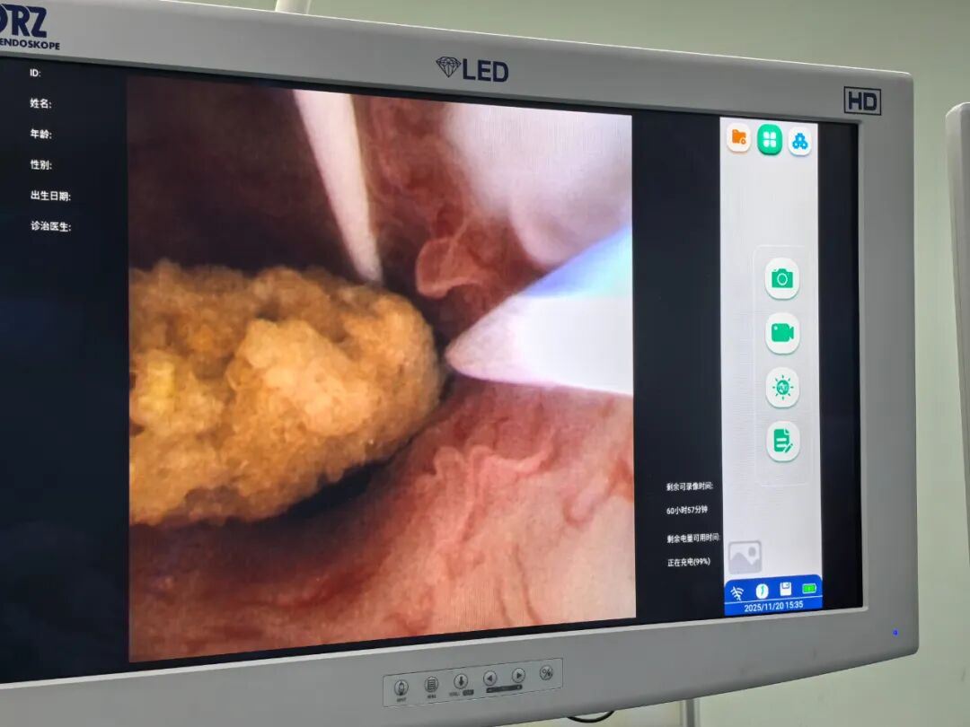 【福德泌尿】攻克复杂移植肾结石难题，重燃患者生命希望