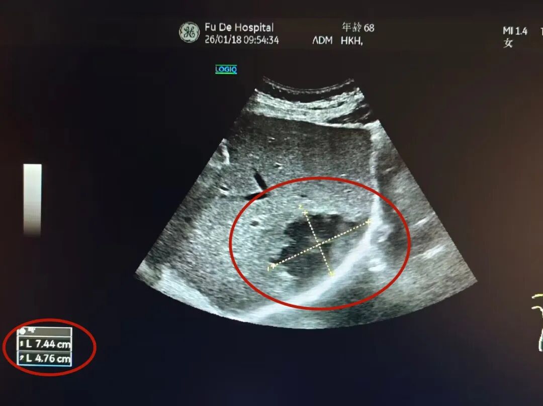 【超声介入】一根细管“穿”破危局！福德医院多学科协作精准守护生命