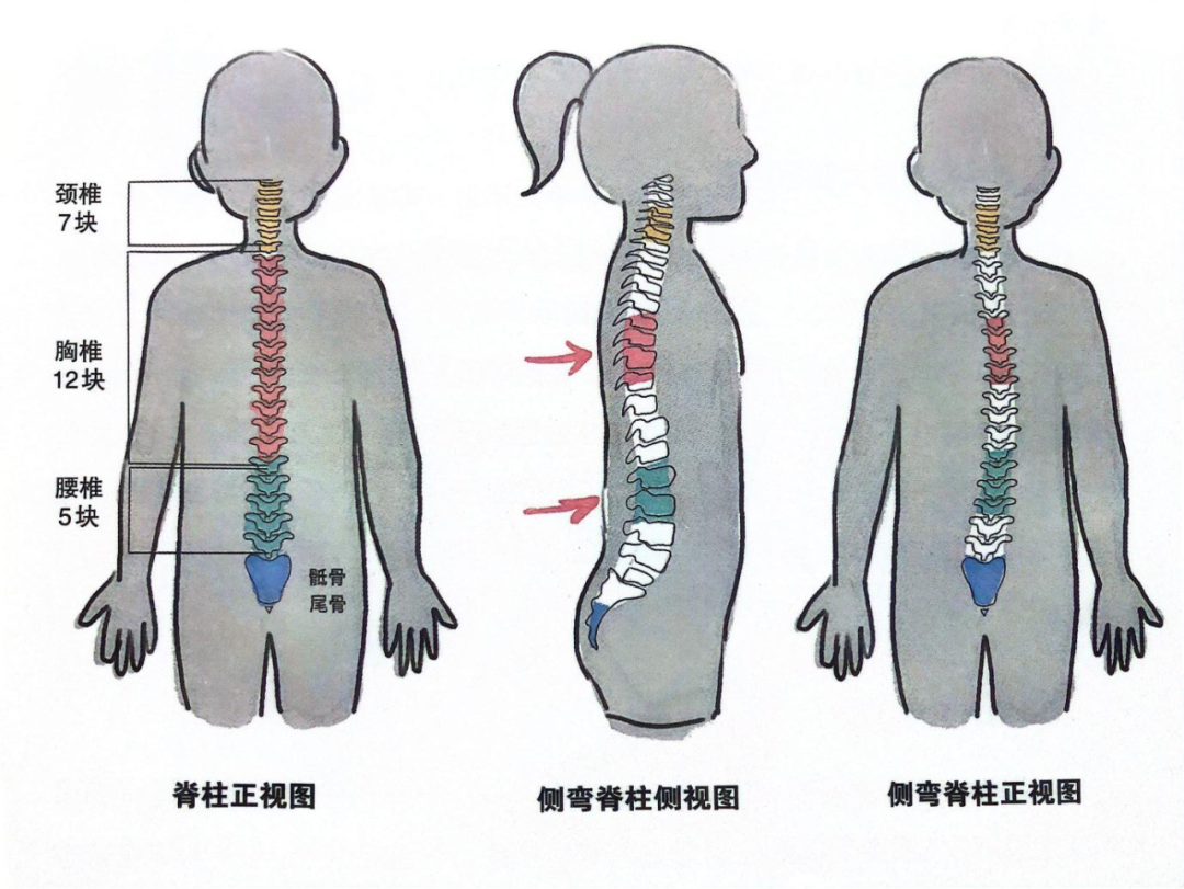 【福德康复】抓住寒假窗口！青少年脊柱侧弯矫正别拖延！ 
