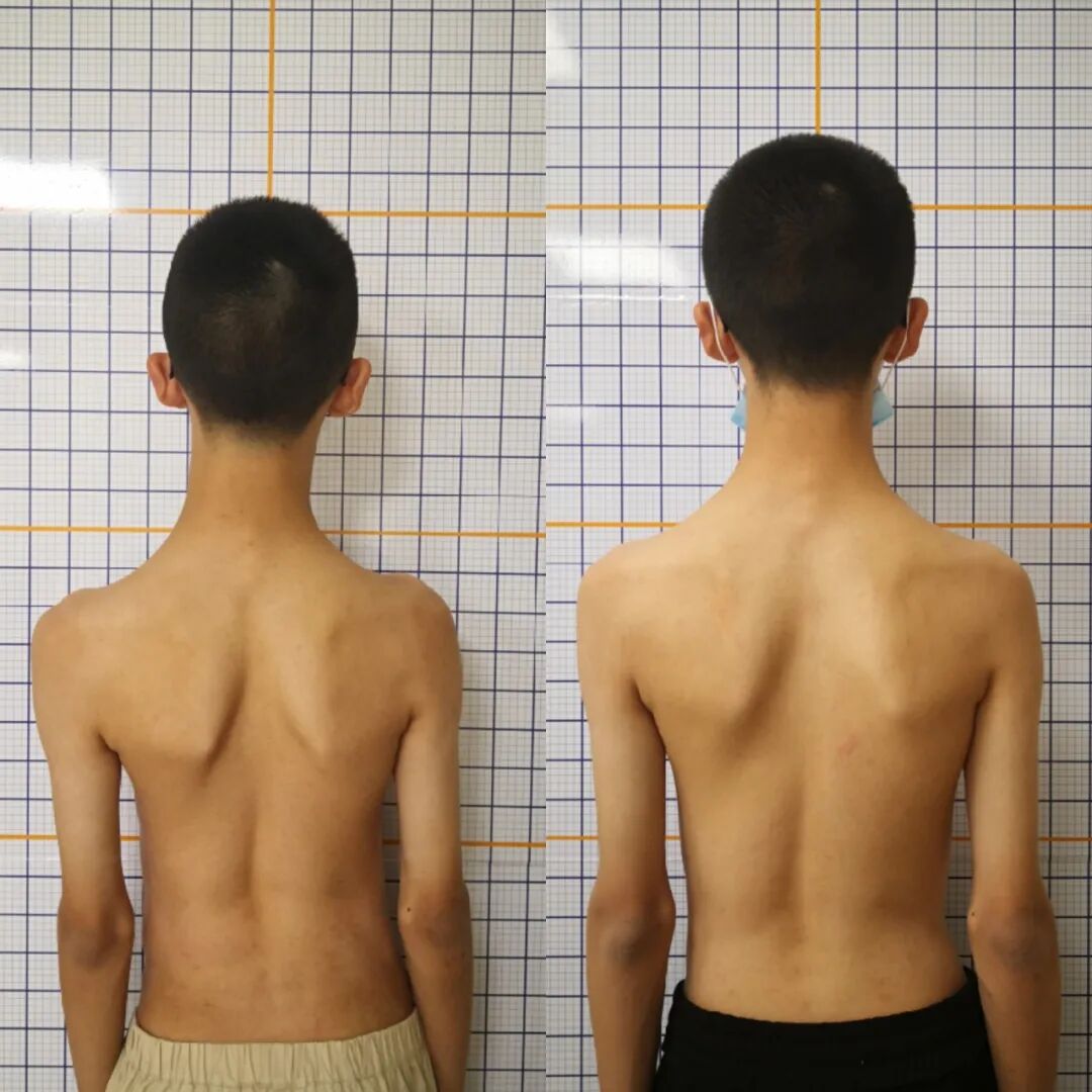 【福德康复】抓住寒假窗口！青少年脊柱侧弯矫正别拖延