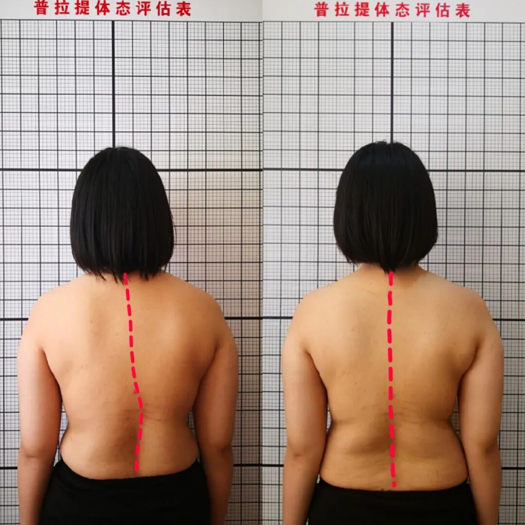 【福德康复】抓住寒假窗口！青少年脊柱侧弯矫正别拖延