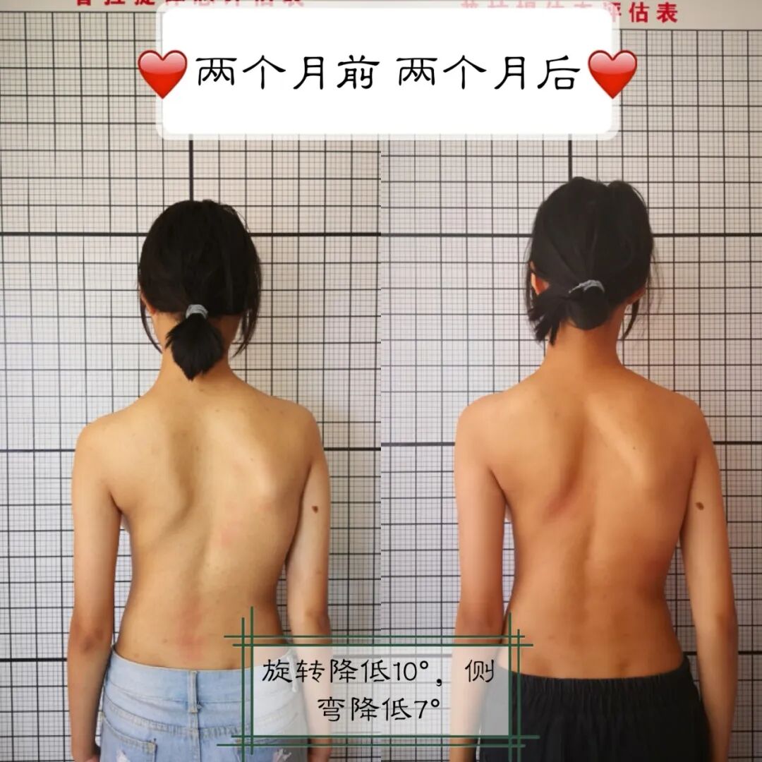 【福德康复】抓住寒假窗口！青少年脊柱侧弯矫正别拖延