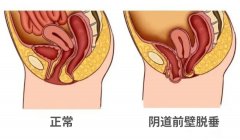 【福德妇科】阴道脱垂困扰12年，福德医院妇科助其重获健康