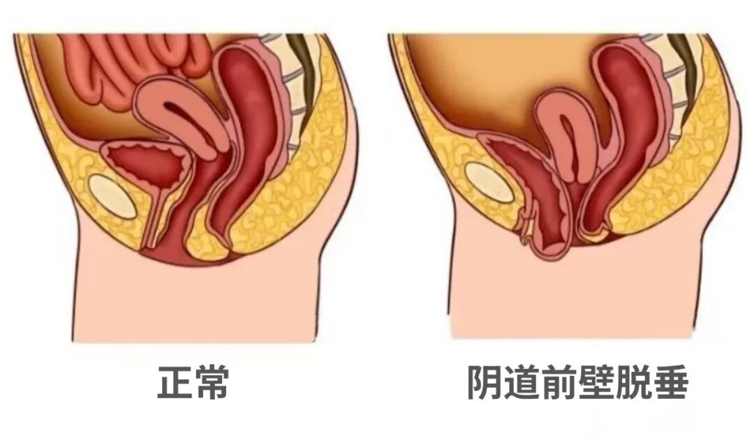 【福德妇科】阴道脱垂困扰12年，福德医院妇科助其重获健康 