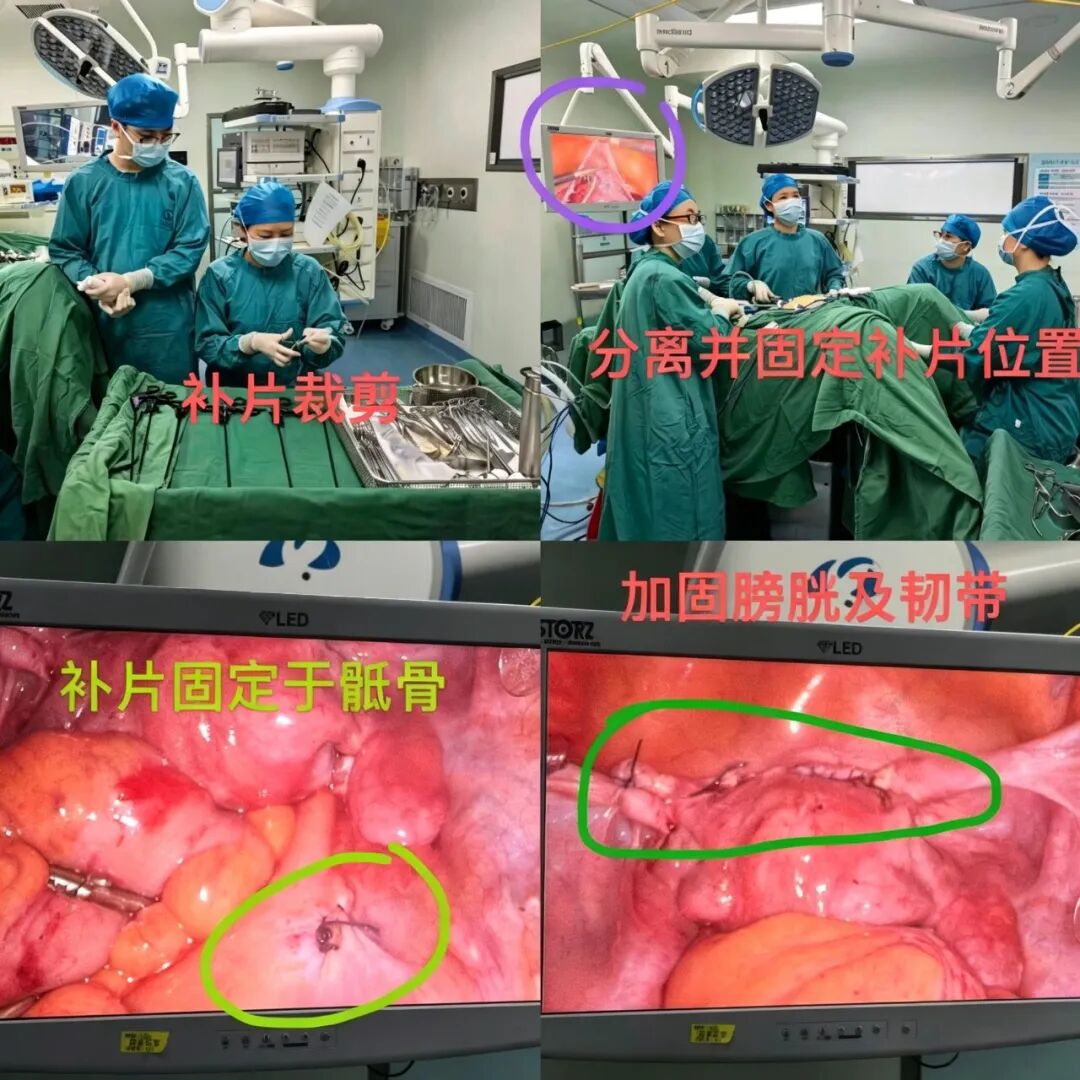  【福德妇科】子宫脱垂怎么办？这个手术保宫护健康→ 
